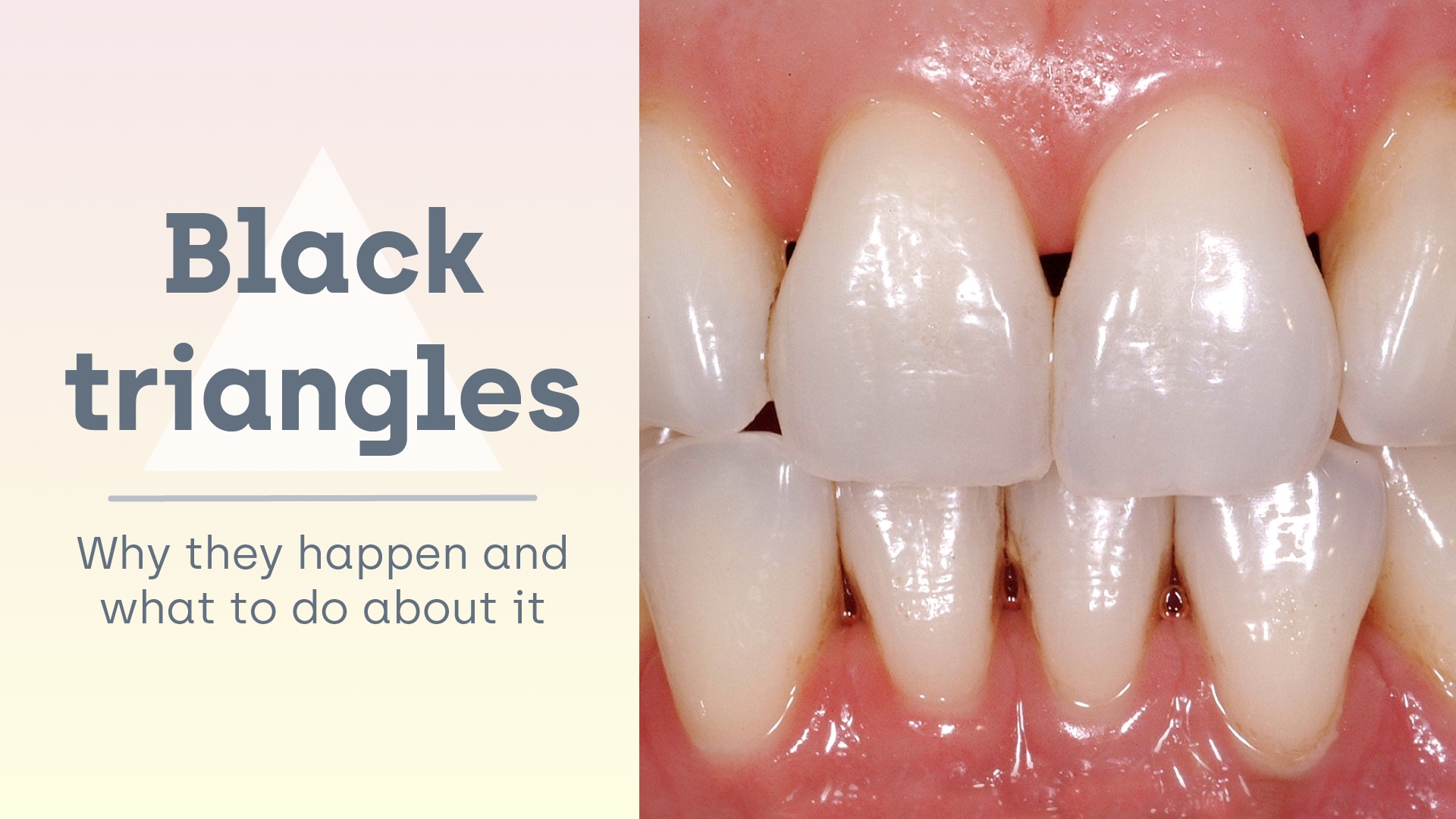 Invisalign Progress Update Gum Recession Gap Teeth Black Triangles Invisalign Progress Update Gum Recession Gap Teeth Black Triangles