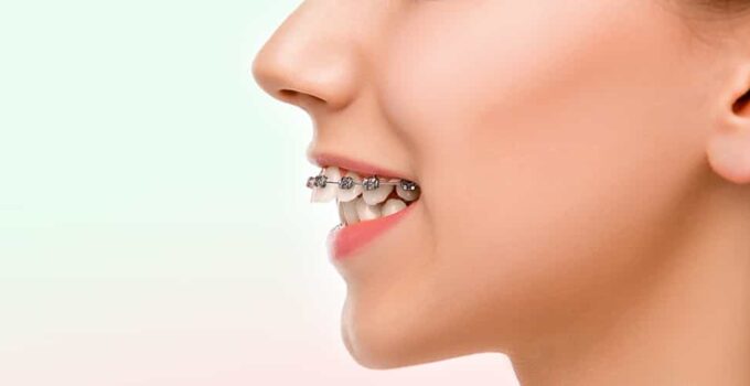 Jaw Misalignment: Fix Your Bite Today