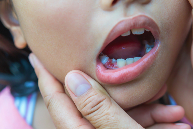 Jaw Pain After Dental Filling