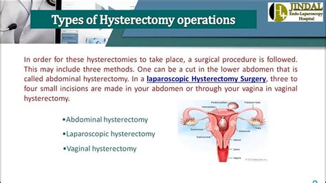 Lap Assisted Hysterectomy