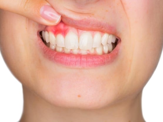 Laser For Gingivitis