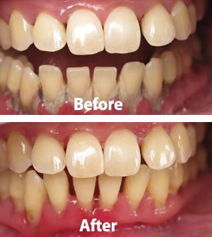 Laser For Periodontal Disease Laser For Periodontal Disease