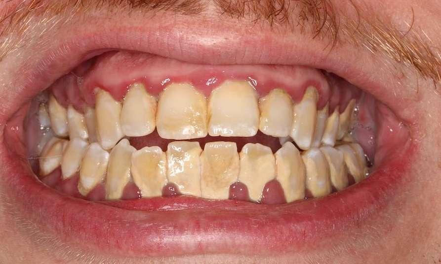 Laser Treatment For Periodontal: Restore Smile