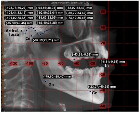 Lateral Cephalometric X Ray With The Mm Ruler On The Left The X Y Axes Lateral Cephalometric X Ray With The Mm Ruler On The Left The X Y Axes