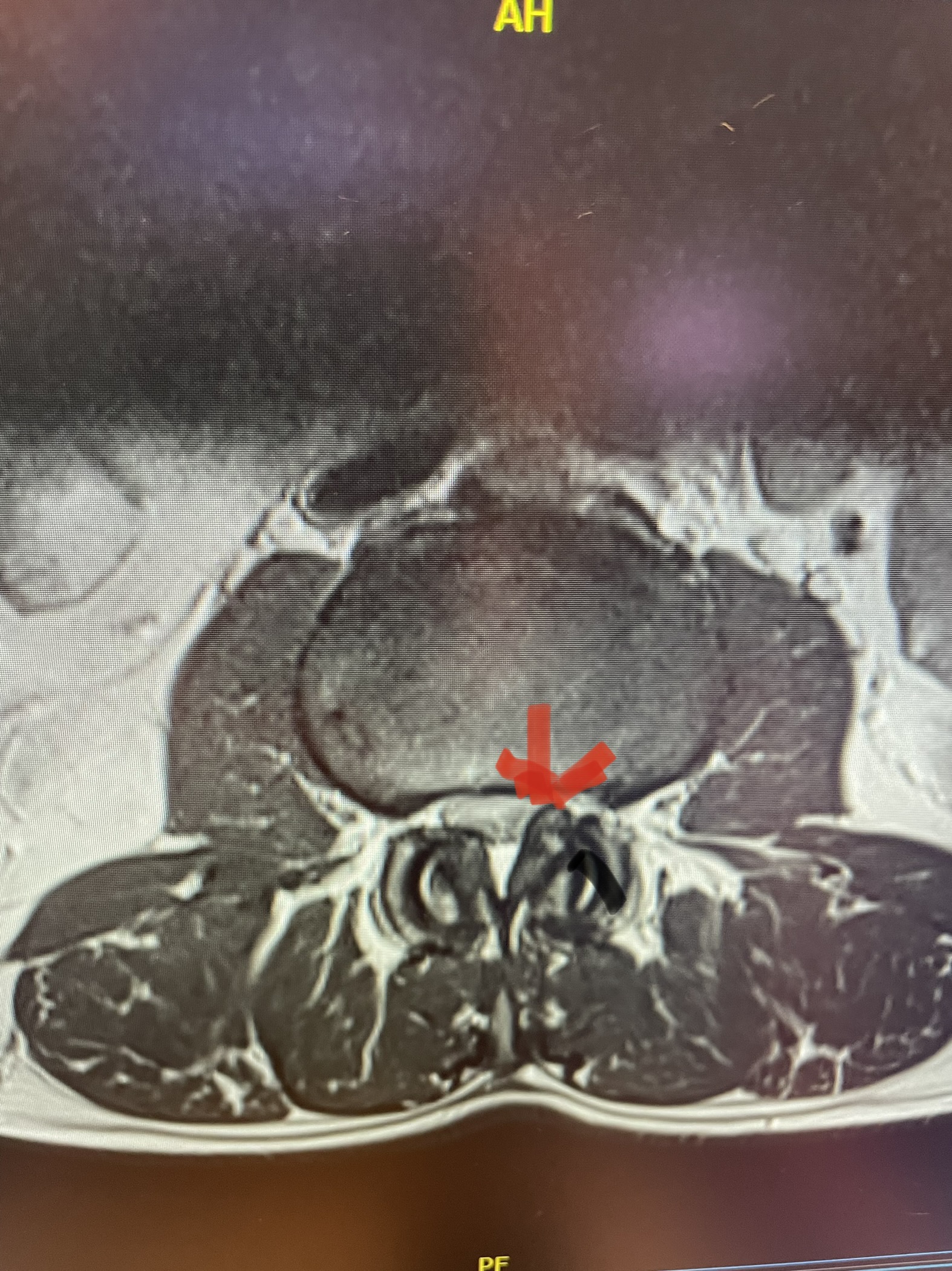 Lateral Recess Effacement
