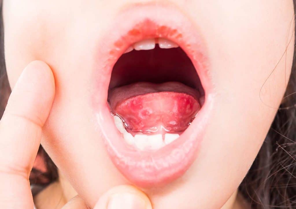 Lesiones En La Lengua