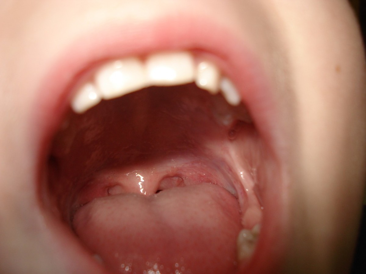 Linea Alba Inside Cheek