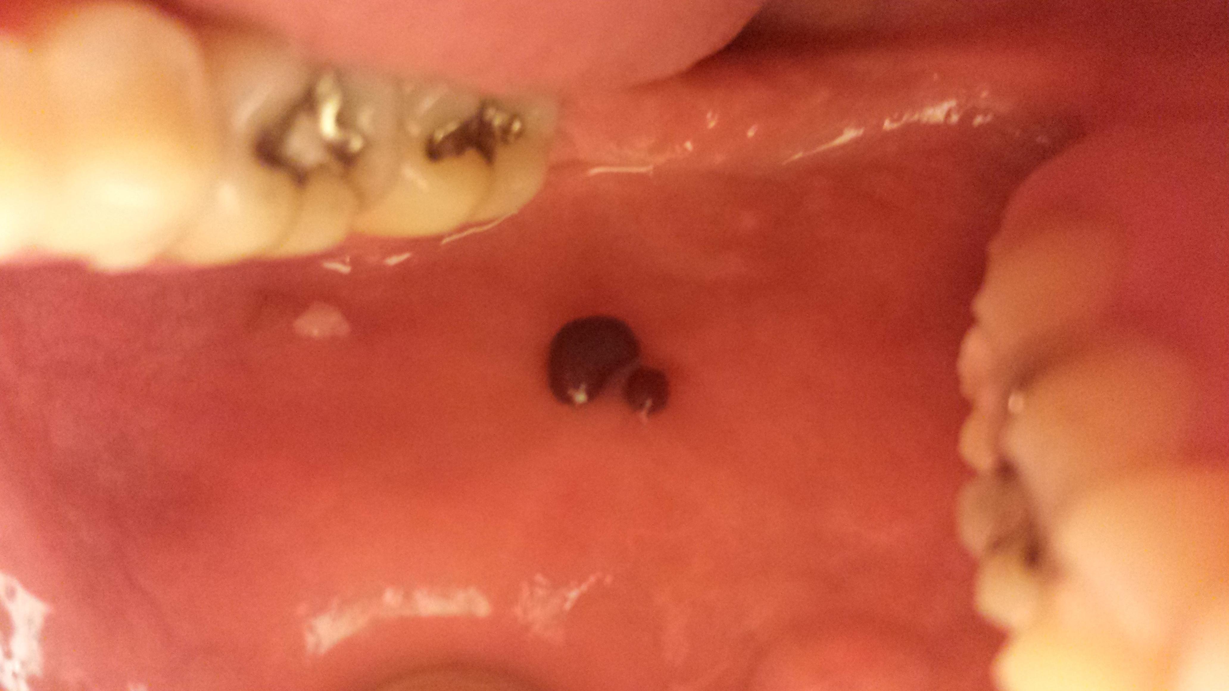 Lines Inside Cheek