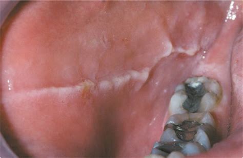 Lines Inside Of Mouth
