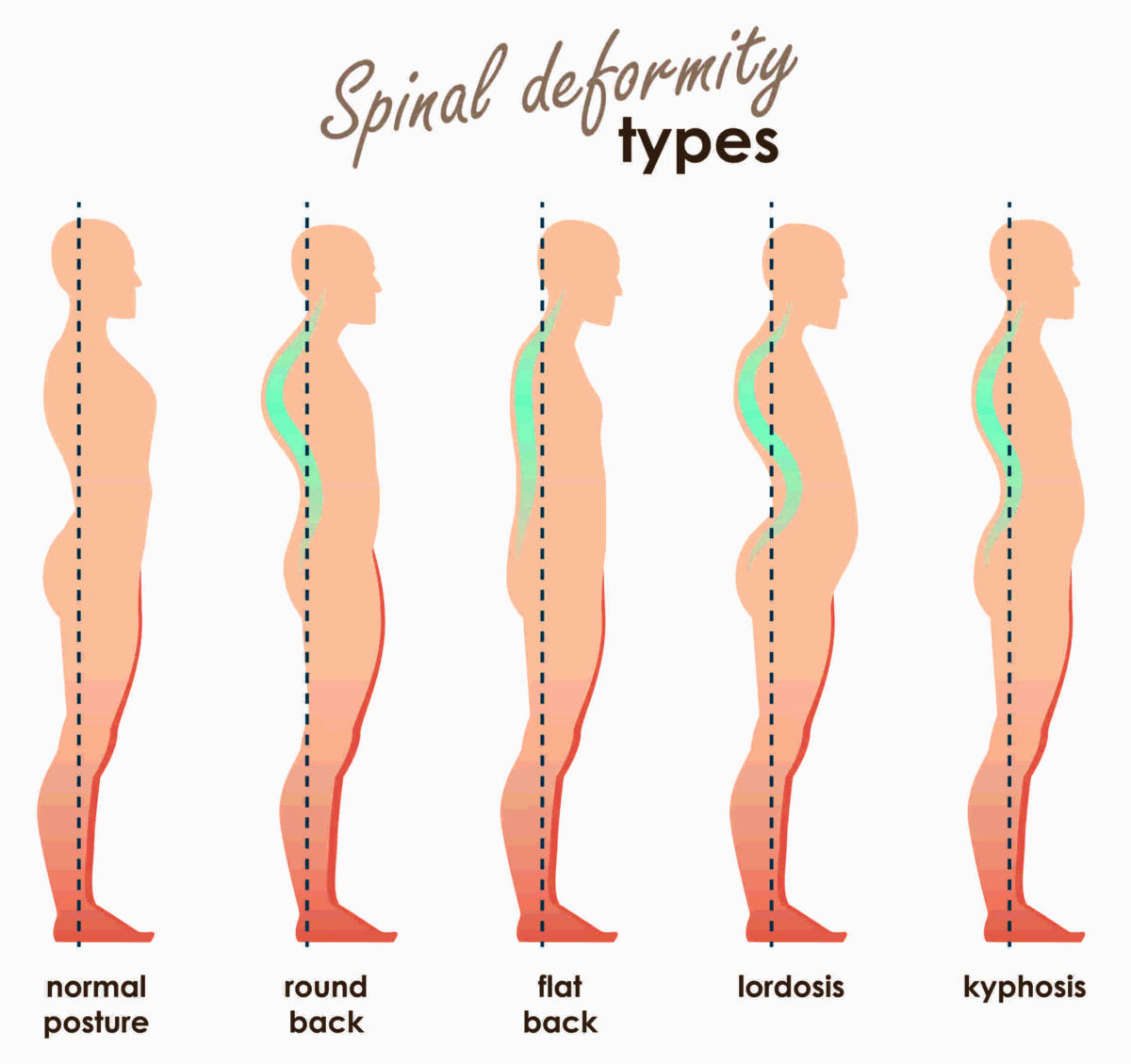 Lumbar Lordosis Or Hyperlordosis Back Care Clinic Lumbar Lordosis Or Hyperlordosis Back Care Clinic
