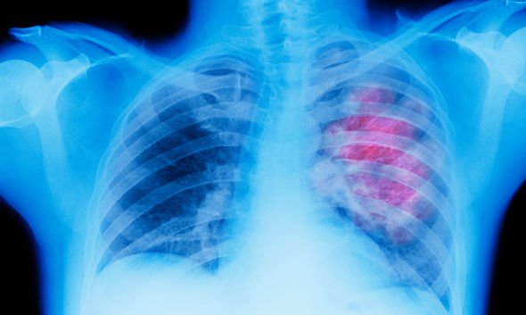 Lung Cancer: Identify Skin Rash Symptoms