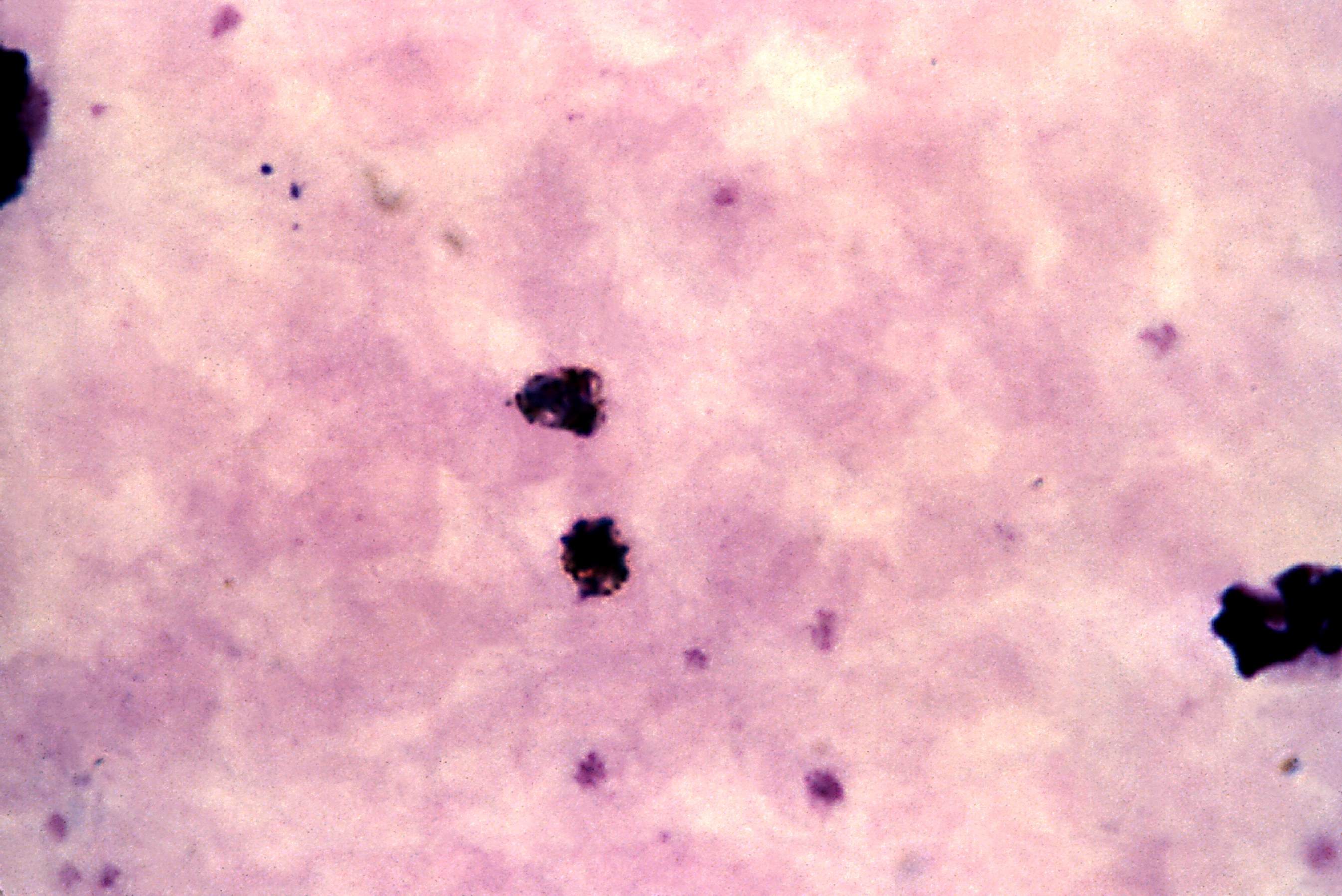 Malaria Smear Guide: Diagnosis Explained