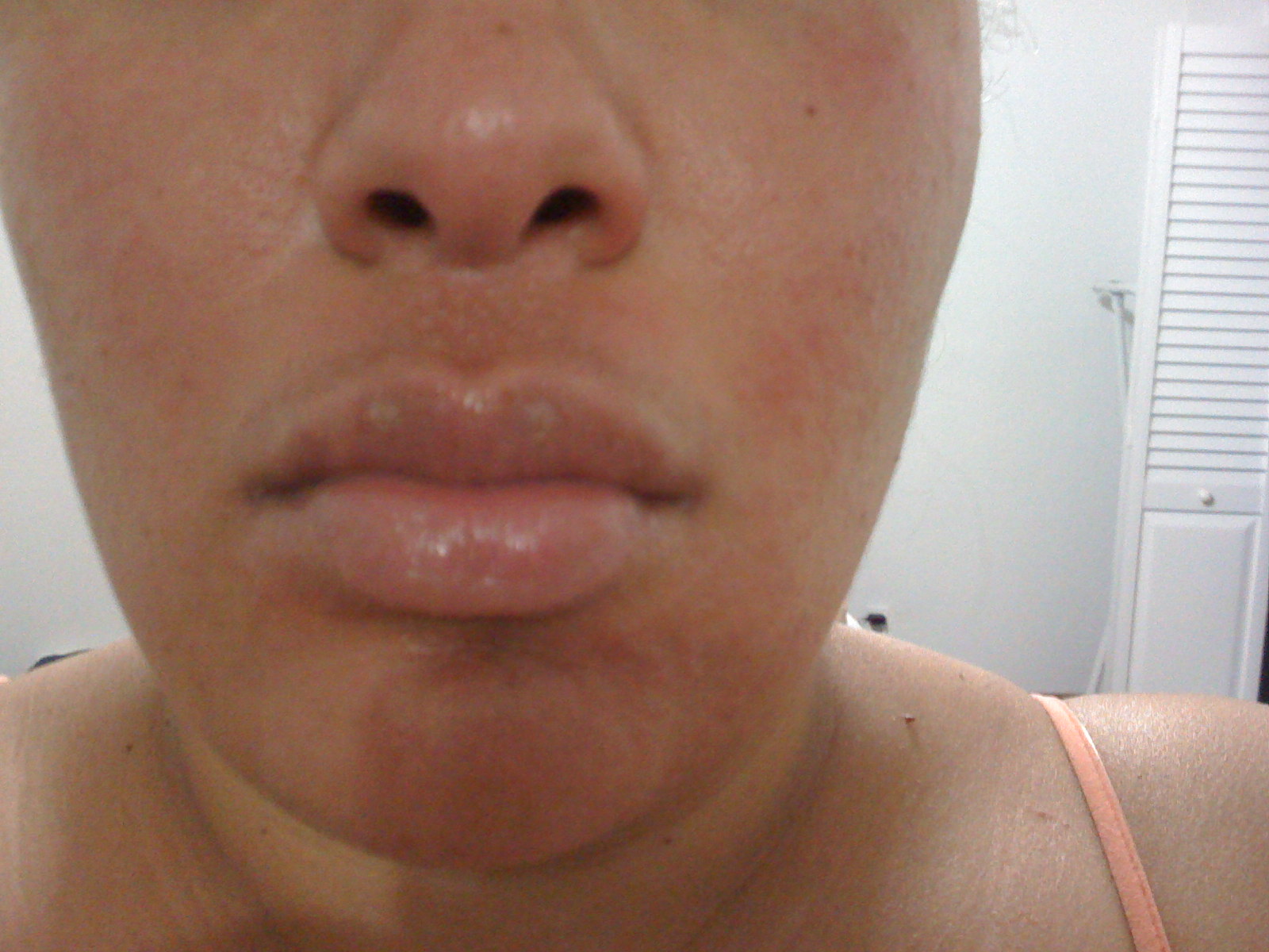 Mango Rash Photos