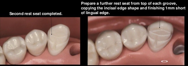 Maryland Bridge Tooth: Restores Smile Quickly