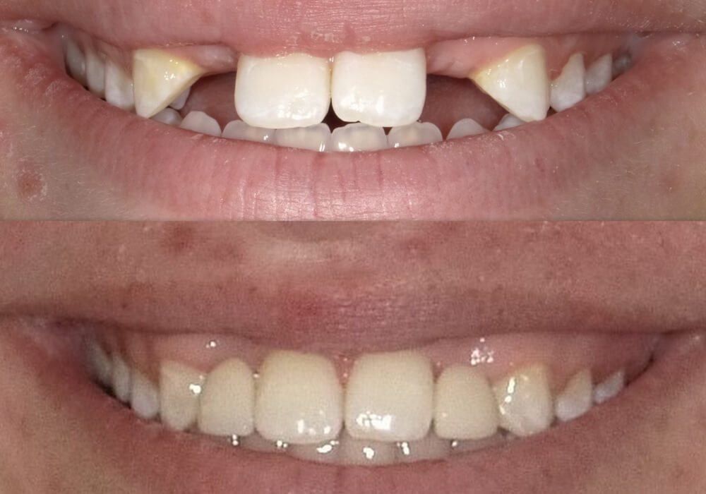 Maryland Dental Bridge Guide: Repair Teeth Easily