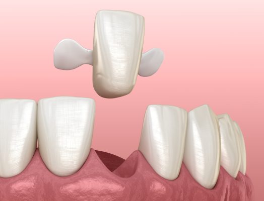 Maryland Dental Bridges