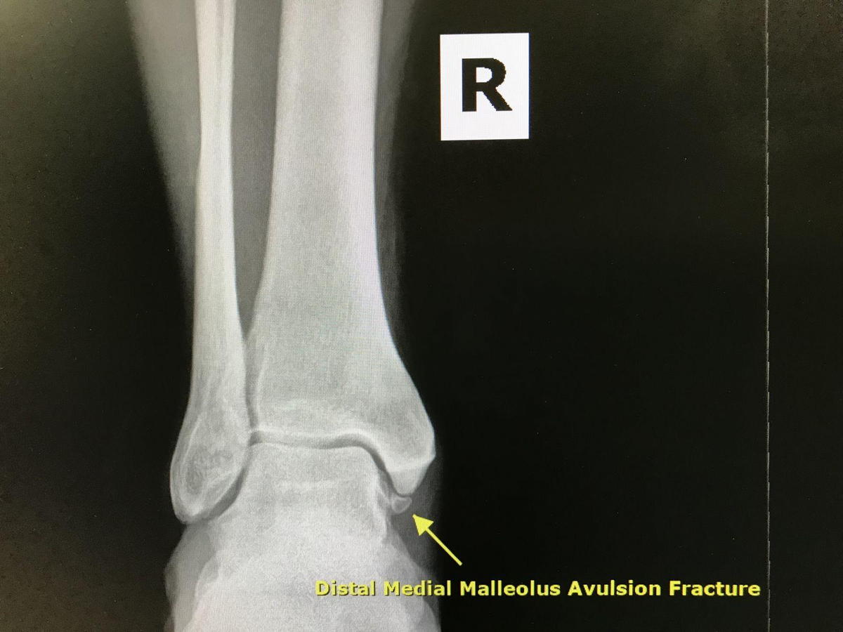 Medial Malleolar Avulsion Fracture