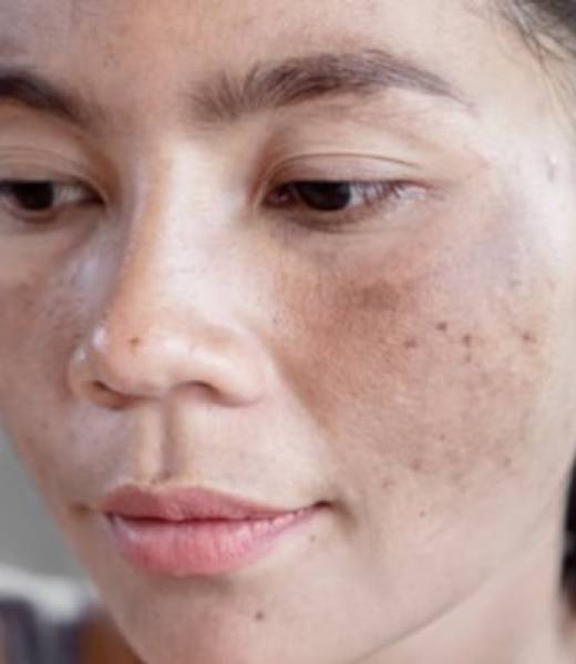 Melasma En La Piel Melasma En La Piel