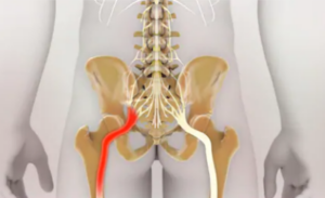 Menstruation And Sciatica