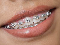 Metal Braces Pricing Explained