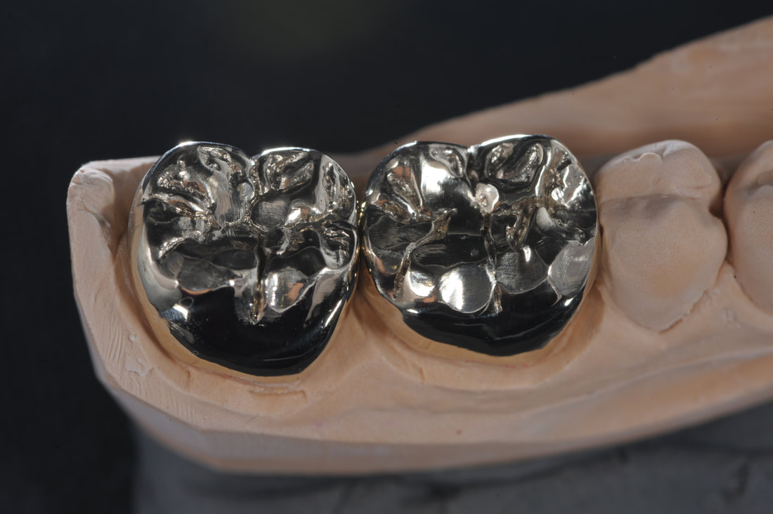 Metal Tooth Crown
