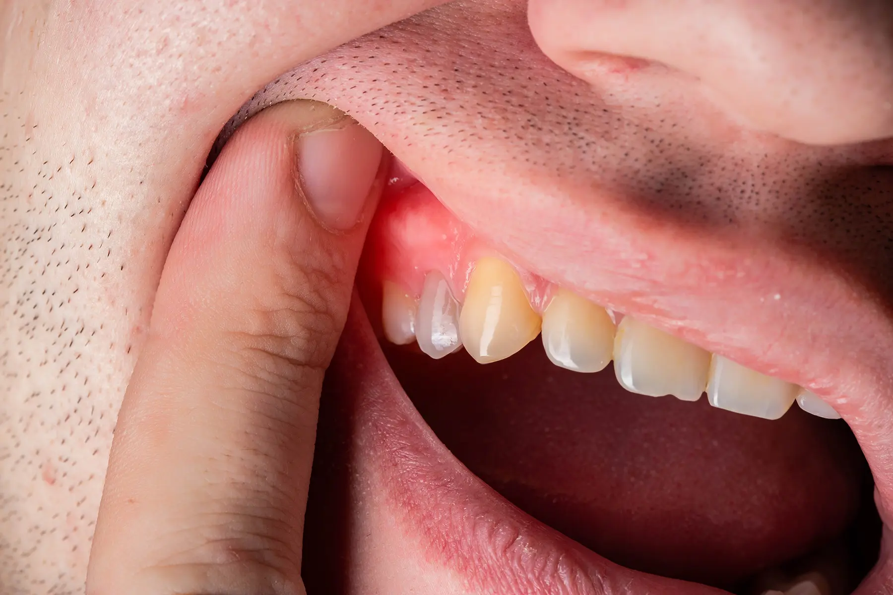 Mouth Wash For Tooth Infection