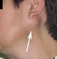 Movable Lump On Jaw Bone: Causes Revealed Movable Lump On Jaw Bone: Causes Revealed
