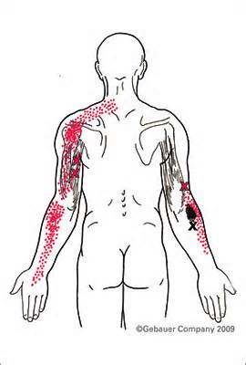 Muscle Tear In Triceps