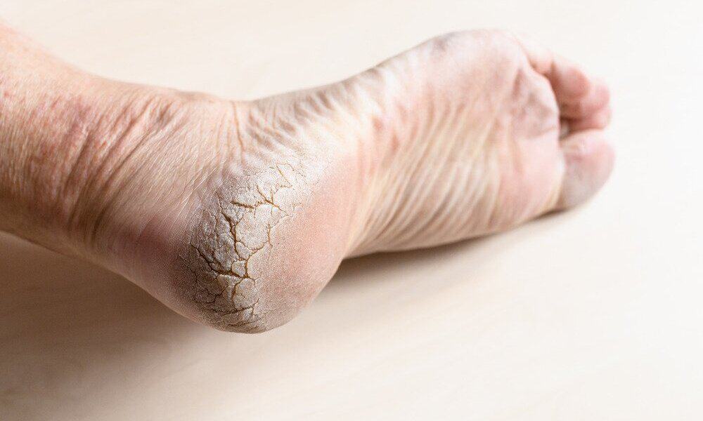 My Feet Are So Dry