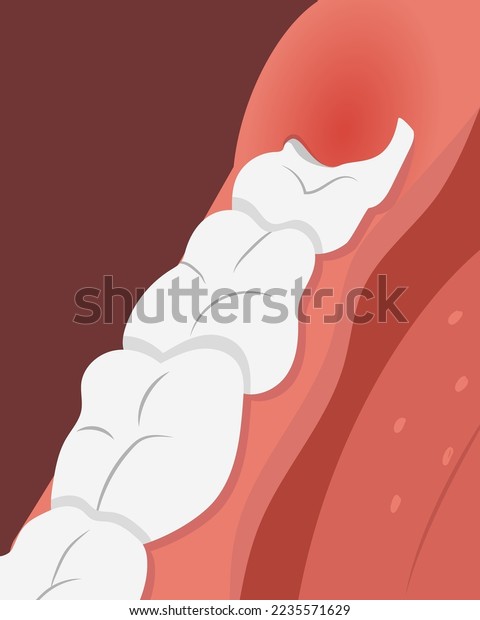 My Gums Growing Over Teeth