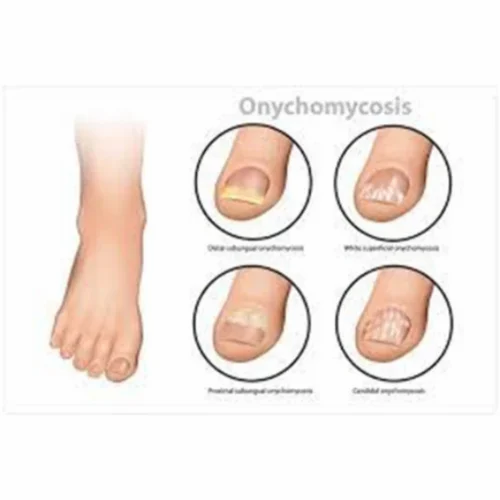 Nail Fungus Treatment In Homeopathy At Peter Petty Blog