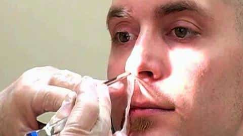 Nose Bleed Cauterization