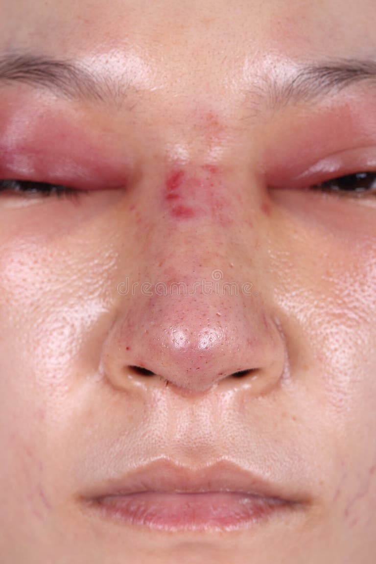 Nose Job Swollen Nose Job Swollen