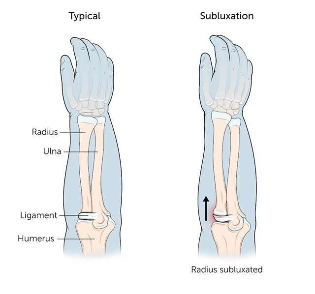 Nursemaid's Elbow Relief: Fast Recovery Guide Nursemaid's Elbow Relief: Fast Recovery Guide
