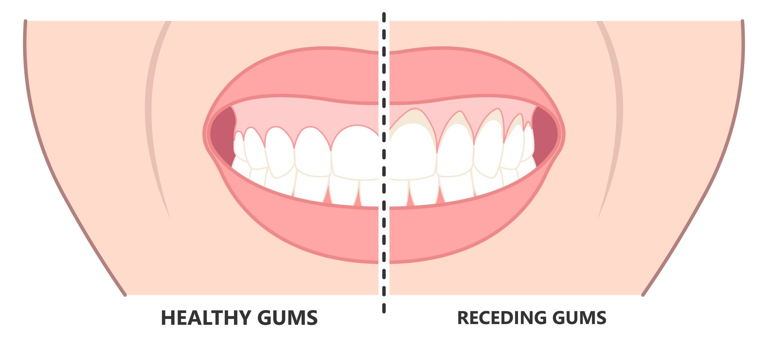 Oil Pulling Receding Gums: Heal In 10 Minutes Daily Oil Pulling Receding Gums: Heal In 10 Minutes Daily
