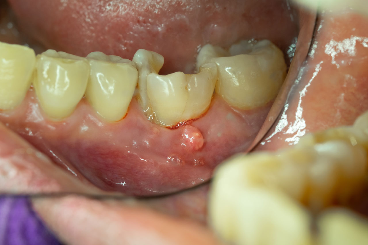 Old Root Canal Infection Symptoms