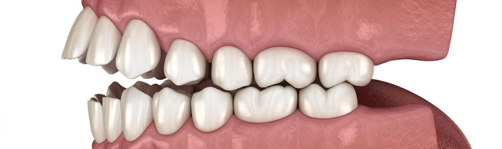 Open Bite Explained: Causes & Corrections