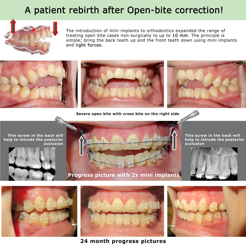 Open Bite Guide: Diagnosis To Treatment