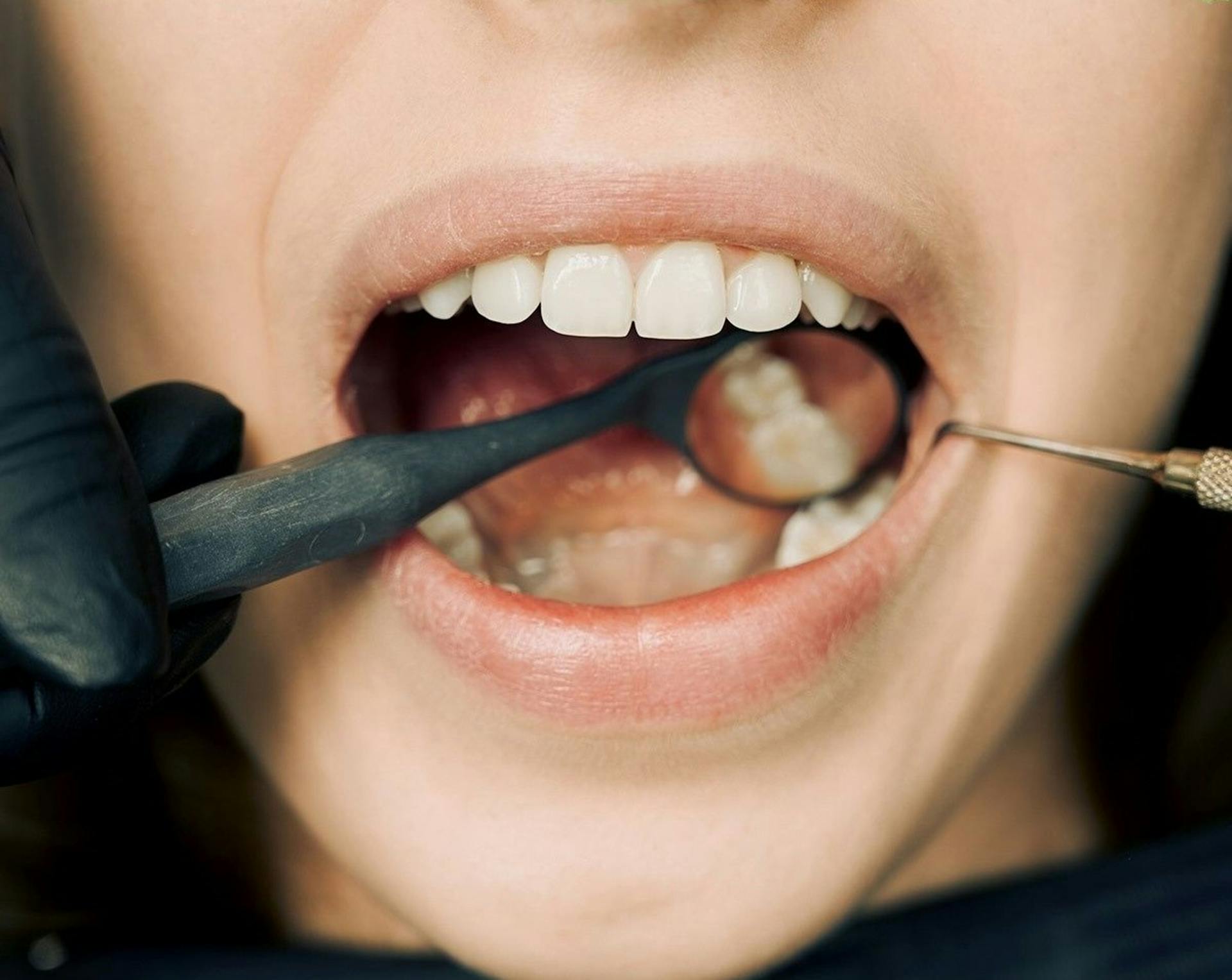 Oral Fibroma Removal Options Oral Fibroma Removal Options