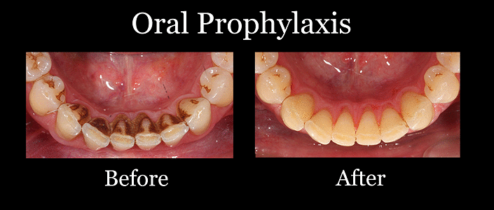 Oral Prophylaxis Meaning