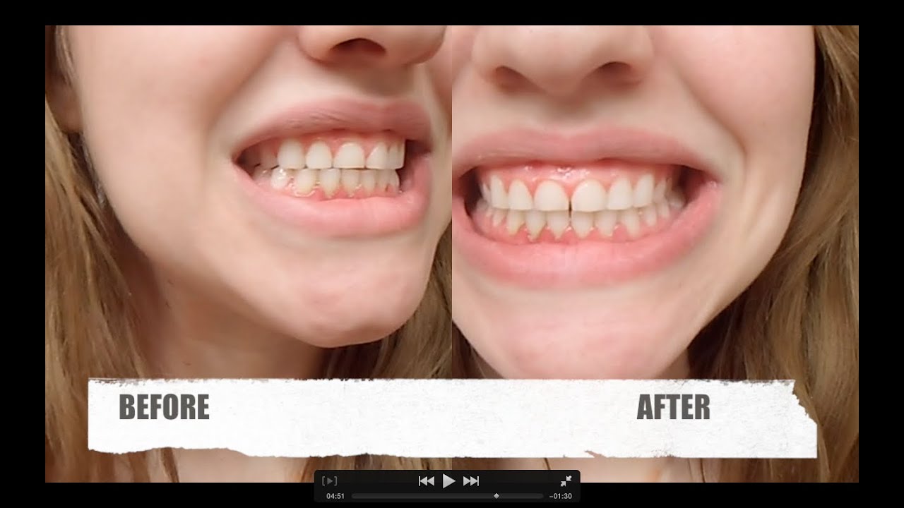 Pain After Teeth Bleaching Pain After Teeth Bleaching