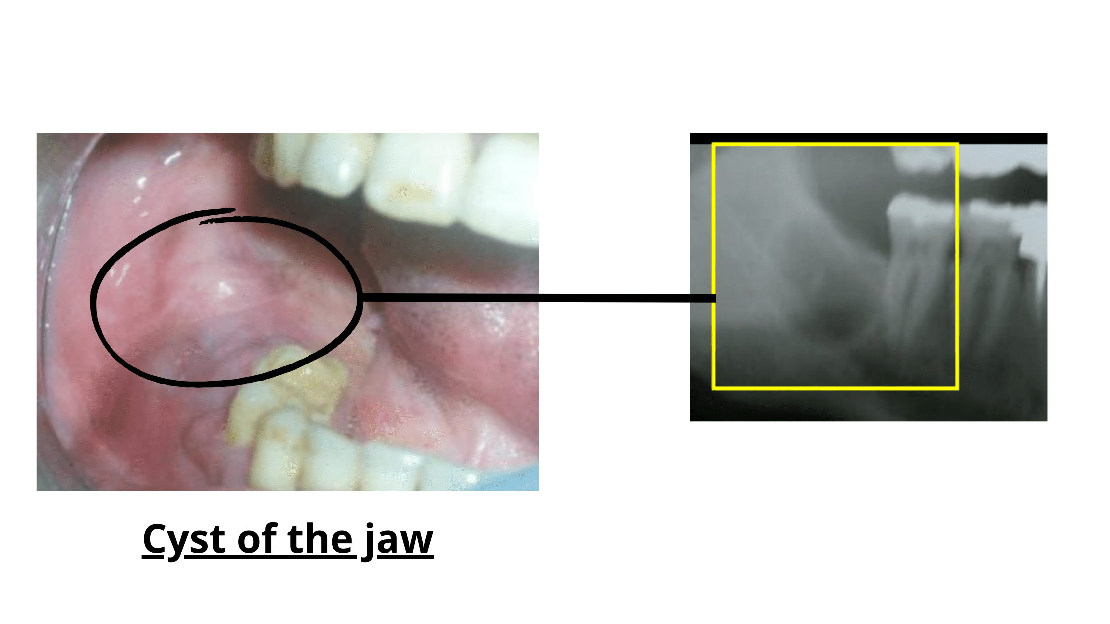 Pain After Wisdom Tooth Extraction