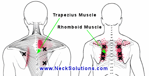 Pain Between Shoulder Solutions Found