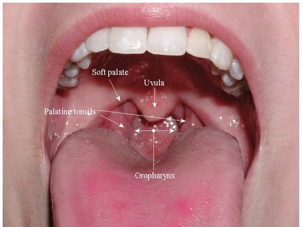 Pain On Soft Palate Pain On Soft Palate