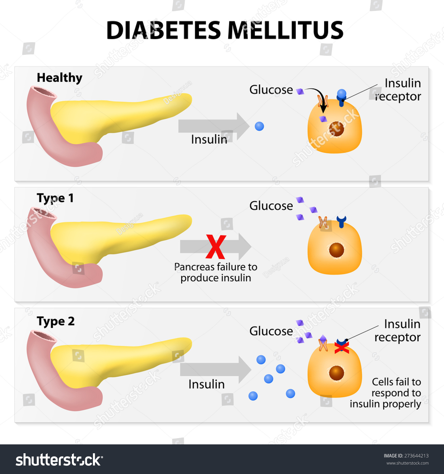 Pancreas Bacteria Diabetes Pancreas Bacteria Diabetes