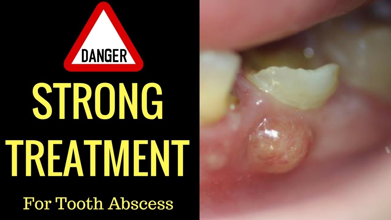 Pediatric Tooth Abscess Treatment