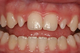 Peg Lateral Teeth Causes: Solutions For Better Bite