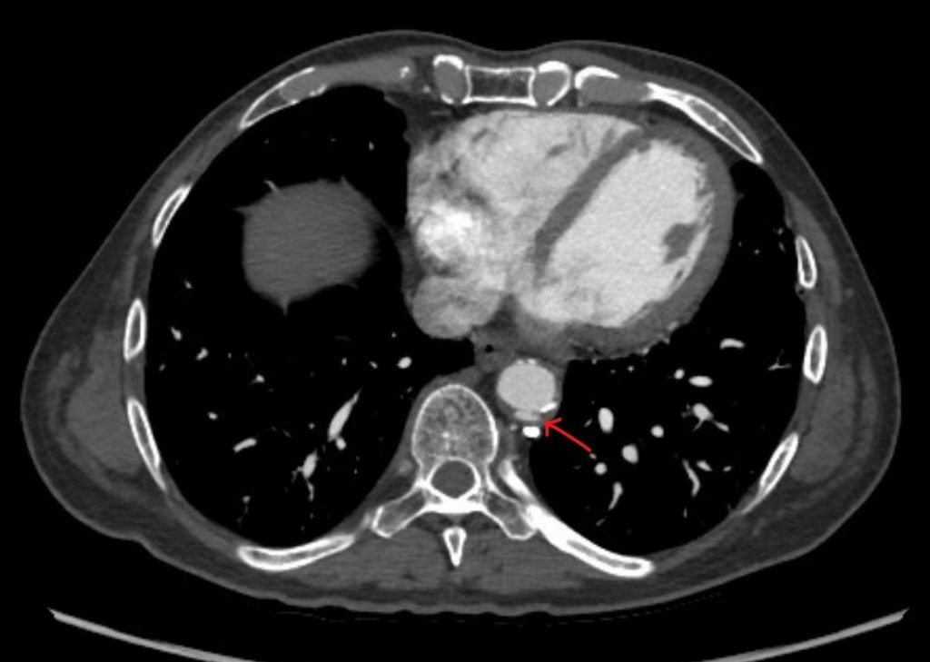 Penetrating Aortic Ulcer Symptoms