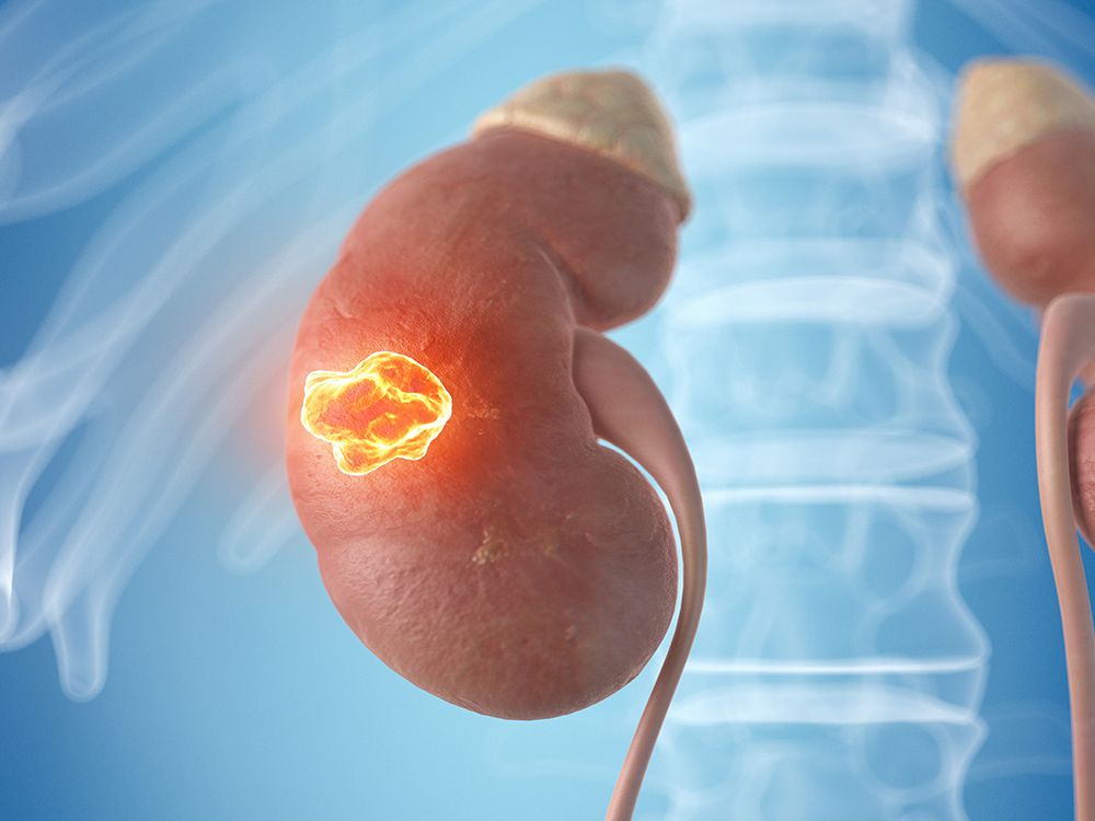 Phosphorus Pyramid For Ckd Provides Diet Advice Renal And Urology News