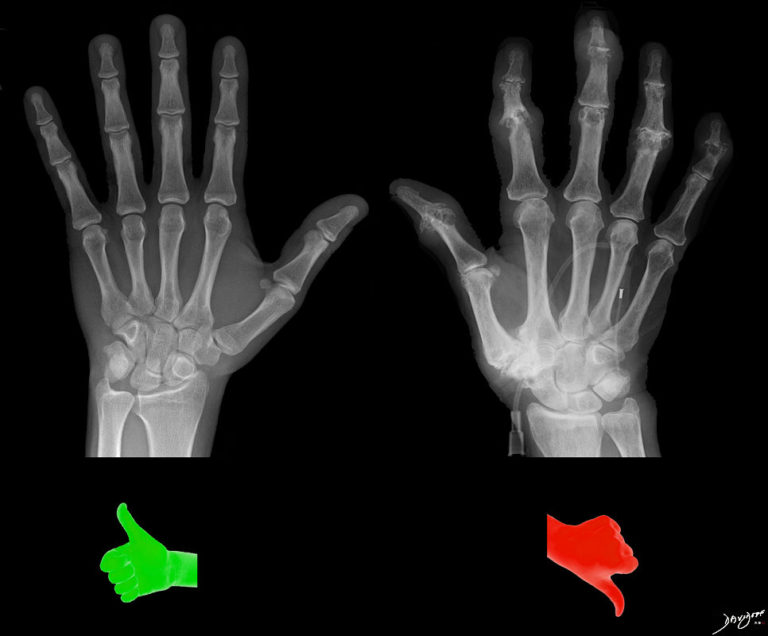 Pictures Of Osteoarthritis Hands